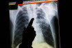 Ilustrační foto - Rentgenový snímek plic, tuberkulóza - ilustrační foto.