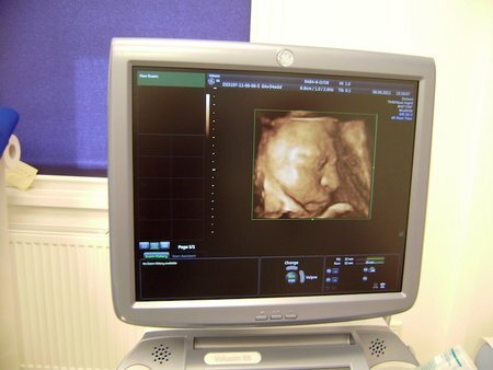 přesnost porodního ultrazvuku lafayette datování