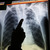 Nejnovější léčbu zatím dostávají desítky pacientů s nádorem plic